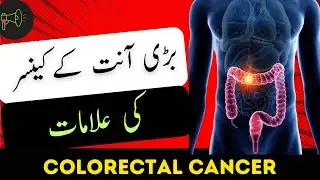 Colon Cancer Symptoms | Bari Aant K Cancer Ki Alamaat| Stool k Sath Blood Ka Ana Aur Wazan Kam Hna