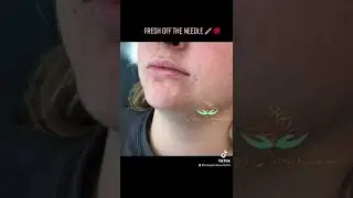 Lip Augmentation, Dermal Fillers Natural, Beautiful Results Los Angeles