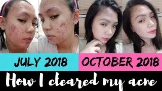 MY ACNE STORY | Skincare for Acne Prone Skin (Philippines) | AshOnTheGo💎