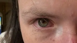Cloudy Vision, Red Eye & Anxiety | What&rsquo;s Really Going On?
