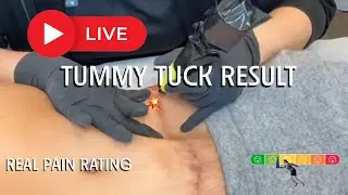 ✨ Tummy Tuck Scar Camouflage | Real Client Experience