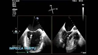 Supporto con Impella durante procedura di Mitraclip. / Impella assisted Mitraclip procedure.