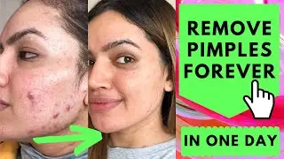 Remove Pimples Forever In 1 Day | Best Acne Treatment | Home Remedy For Pimples