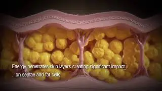 Z-Wave Pro: Cellulite Reduction & Body Contouring