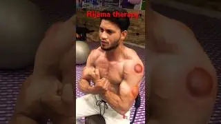 Hijama therapy #shortvideo #youtubeshorts #viral #views #trending #hijama