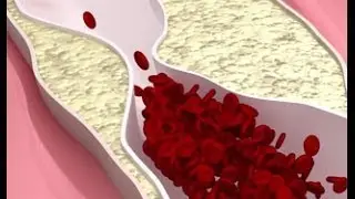 High Cholesterol with Internal Medicine Specialist Dr. Terry Chambless