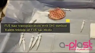 FUE HAIR TRANSPLANT WITH DHI METHOD KALEM TEKNİĞİ İLE SA&Ccedil; EKİMİ
