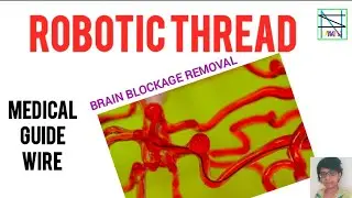 &bull;ROBOTIC THREAD&bull;BRAIN BLOCKAGE REMOVAL&bull;SCIENCE & TECH&bull;TAMIL&bull;MEDICAL GUIDE WIRE&bull;MAGNETIC FIELD&bull;