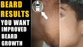 Beard growth results| You want improved beard growth | We know hair