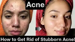 How to Get Rid of Acne at ANY Age | Dermatologist-Approved Skincare Guide