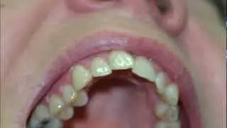 Treating crowded teeth with invisalign