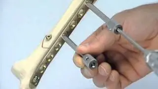 INTERNAL FIXATOR distal tibia