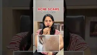 How to treat acne scars | Acne Scars | Acne Scar Treatments that work | How to fix acne scars?