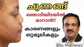 ശരീരത്തിലെ ചുണങ്ങ്  അതിവേഗം മാറാന്&zwj; ചില ഒറ്റമൂലികള്&zwj; | Natural remedies for tinea versicolor