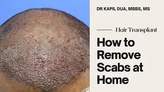 How to Remove Scabs after Hair Transplant at Home | Dr Kapil Dua