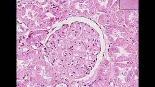 Histopathology Kidney --Systemic lupus erythematosus