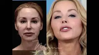 Dr. Marc Mani performs his HD Lift&trade;️ on Darnell Cox of LiveYoungLifestyle