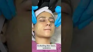 Yellow Peel Skin lightening peel.Skin Smile Clinic Bhopal ☎️9691918200