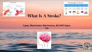 STROKE-Types,Mechanism,BE FAST Signs,TIA,Risk Factors