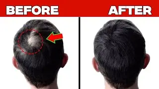 10 Natural Ways to Regrow Hair Faster | Before & After Results