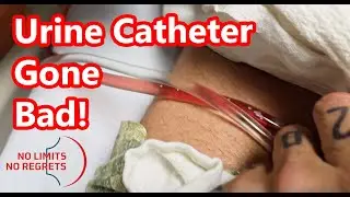 Urinary CATHETER PROBLEMS - Heart Surgery Gone Bad & Problem with Catheter