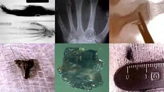 Unraveling the Mystery of Alien Implants: Dr. Roger Leir's Legacy