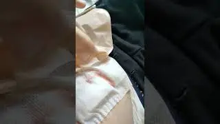 швы в больнице на живую