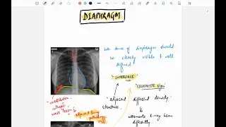 DIAPHRAGM ON A CHEST XRAY ! how to assess diaphragm ?