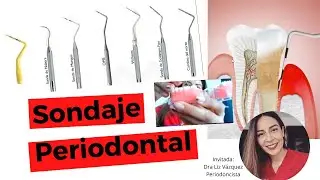 SONDAJE PERIODONTAL