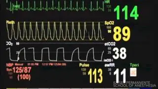 Bronchospasm 2 - Patient Monitor