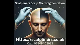 &ldquo;Scalp Micropigmentation in Kent: Restore Your Hairline with SMP By Scalpliners UK&rdquo;