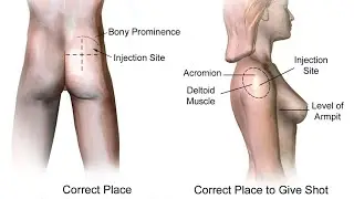 Intramuscular injection|how to give IM injection in Adult|Pediatric|Neonatal #nursingstudent #viral 