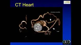 A Road Less Traveled - Preservation of Right Coronary Artery Flow - Benjamin Stripe, MD