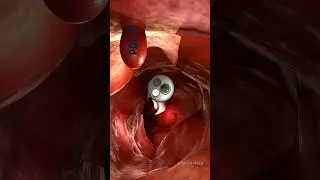 ENDOSCOPIC PROCEDURE | Endoscopic view of our Intestine 🧑&zwj;⚕️#healthfield  #medicineknowledge