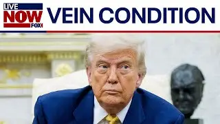 President Trump diagnosed with chronic venous insufficiency: what is it?
