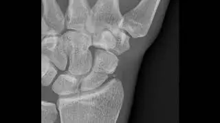 Scaphoid Fracture (Xray 2)