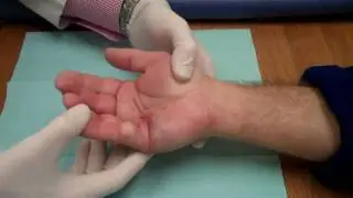 Xiaflex Injection - Manipulation for Dupuytren's Contracture