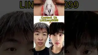 #鼻整形 #Rhinoplasty #鼻修复 #noserepair #nose