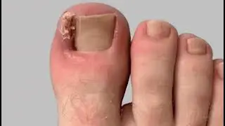 Diabetic foot #Diabetic foot Ulcer# Amputation # Foot care# Diabetes and foot care# Foot Trauma care