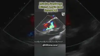 Marfan Syndrome - Dilated Aortic Root #Echo