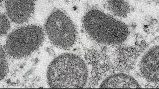Monkeypox vaccines, testing becoming more available