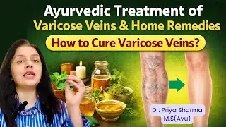 Fix Varicose Veins easily and naturally!! Watch till end !