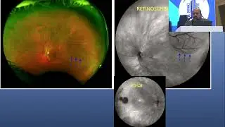 AIOC 2023   IC9   topic Dr  SHARAD BHOMAJ COLOR FUNDUS PHOTOGRAPY