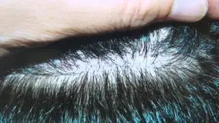 FUE Minimal Scar Fix Linear Hair Loss Transplantation near San Francisco Dr. Diep www.mhtaclinic.com