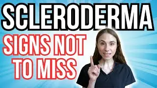 Signs Of Scleroderma NOT TO MISS