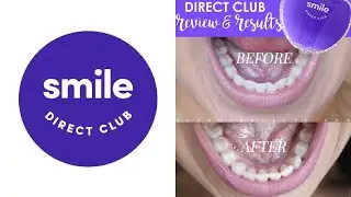 Is Smile Direct AScam ??? My Experience with Smile Direct