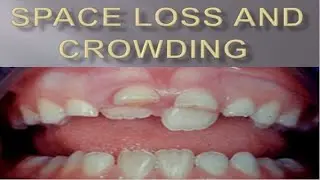 Space loss and crowding