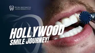 Hollywood Smile Journey!