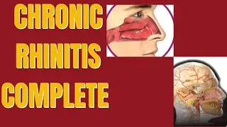 Chronic Rhinitis complete 