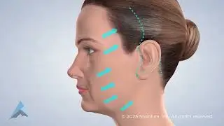 Facelift in Boise and Meridian, ID